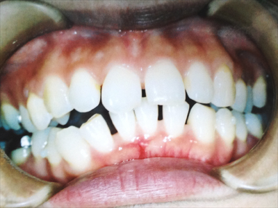 teeth04